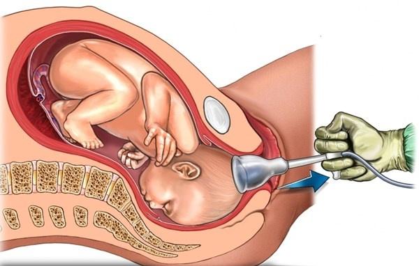 Hút thai có ảnh hưởng gì không?