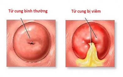 Bệnh viêm tử cung: nguyên nhân, triệu chứng và cách chữa trị
