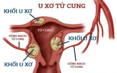 Triệu chứng u xơ tử cung: Chị em chớ coi thường!