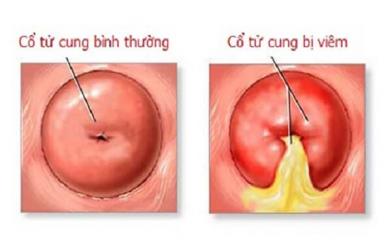 Chữa viêm cổ tử cung không còn là nỗi lo nếu bạn biết cách này