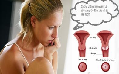 Chữa viêm lộ tuyến cổ tử cung ở đâu tốt nhất Hà Nội?