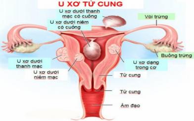 Tìm hiểu bệnh u xơ tử cung – Nữ giới đừng chủ quan