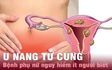 U nang tử cung – Bệnh phụ nữ nguy hiểm hiếm gặp