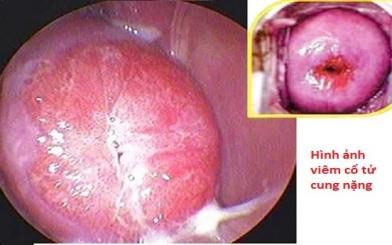 Viêm cổ tử cung nặng và cách điều trị hiệu quả
