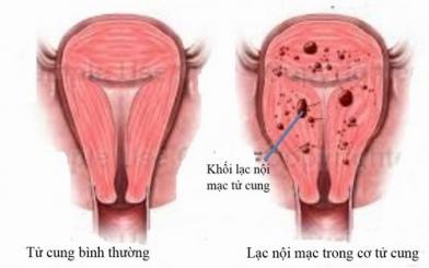 Bệnh lạc nội mạc tử cung – Nguyên nhân và cách điều trị