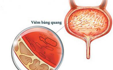 Bị bệnh viêm bàng quang có nên quan hệ không?