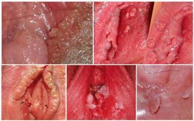 Môi nhỏ có hạt – Cảnh báo bệnh nguy hiểm!