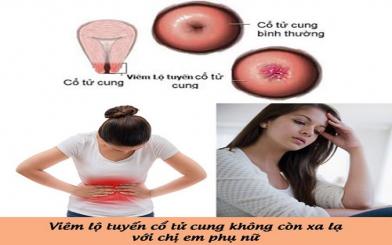  Viêm cổ tử cung có chữa khỏi được không? Làm sao chữa khỏi?