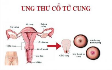 Phương pháp chẩn đoán ung thư cổ tử cung mới nhất 