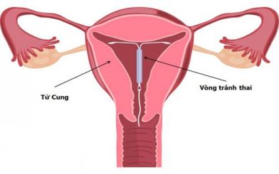 Vòng tránh thai (dụng cụ tử cung) [Tổng hợp kiến thức đặt+ tháo]
