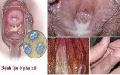 Bệnh lậu ở phụ nữ nguyên nhân do đâu? Điều trị thế nào?