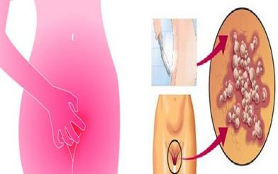 Vùng kín bị ngứa rát ở nữ có phải bệnh lậu?