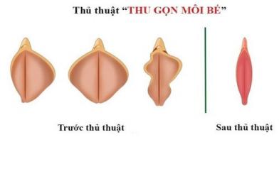 Cắt môi bé: Quy trình, chi phí, địa chỉ thực hiện