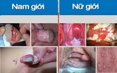 Viêm vùng kín ở nam và nữ: Biết cách trị sẽ ổn!