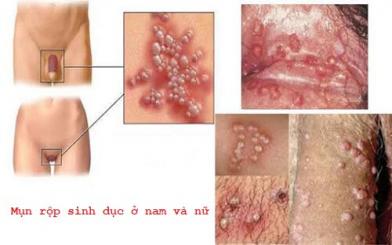 Tìm hiểu về bệnh mụn rộp sinh dục ở nam và nữ giới