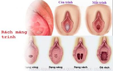 Rách màng trinh: Nguyên nhân, triệu chứng, giải pháp