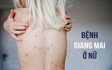 Bệnh giang mai ở nữ và cách chữa dứt điểm