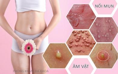 Mọc mụn ở âm vật- Nguy cơ sùi mào gà 98%!