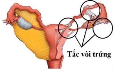 Tắc vòi trứng [Kiến thức tổng hợp từ A-Z]