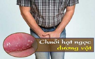 Chuỗi hạt ngọc bao quy đầu: Nguyên nhân và cách điều trị 