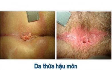 Cắt da thừa cạnh hậu môn [Những thông tin quan trọng]
