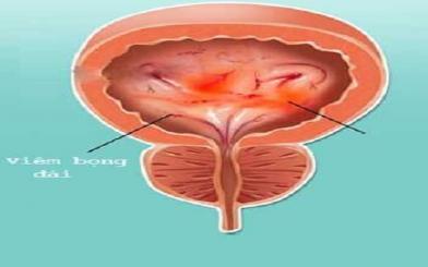 [Góc giải đáp] Viêm bọng đái và một số kiến thức liên quan