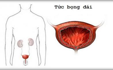 Tức bọng đái – Bật mí cách chữa hiệu quả