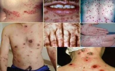 Tiết lộ: Chi phí điều trị giang mai từng khoản