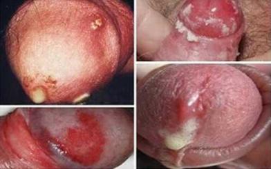 Bệnh lậu ở nam giới: Nguyên nhân, triệu chứng, cách điều trị
