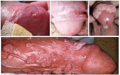 Sùi mào gà ở nam: Nguyên nhân, triệu chứng và cách điều trị