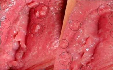 Sùi mào gà ở phụ nữ: Nguyên nhân, dấu hiệu & cách chữa