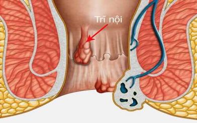 Điều trị trĩ nội bằng phương pháp nào thì hiệu quả?