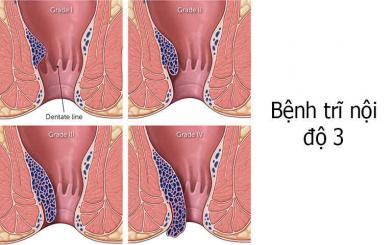 Điều trị trĩ nội độ 3 tại nhà có triệt để và an toàn?