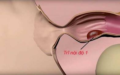 Bệnh trĩ nội cấp độ 1: Dấu hiệu và cách chữa tại nhà