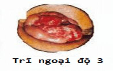 Bệnh trĩ ngoại độ 3: Dấu hiệu nhận biết & cách chữa trị