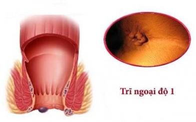 Bệnh trĩ ngoại cấp độ 1 có nguy hiểm không? Chữa thế nào?