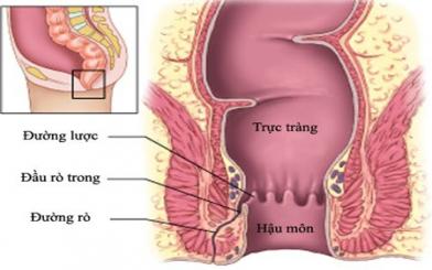 [CẢNH BÁO ] 6 bệnh lý ở hậu môn trực tràng thường gặp