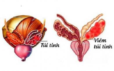 [CẢNH BÁO] Dấu hiệu viêm túi tinh nam giới cần biết