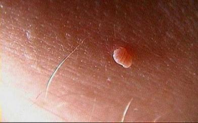 [Vấn đáp] Mọc mụn thịt ở vùng kín và cách khắc phục