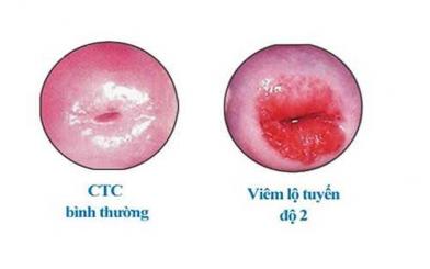 Viêm lộ tuyến cổ tử cung cấp độ 2: Triệu chứng & cách điều trị