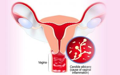 Nấm candida ở phụ nữ và phác đồ điều trị hiệu quả