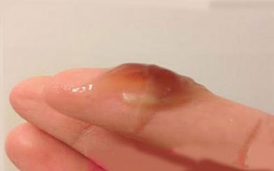 Cảnh báo nguy hiểm khi ra chất nhầy màu nâu!