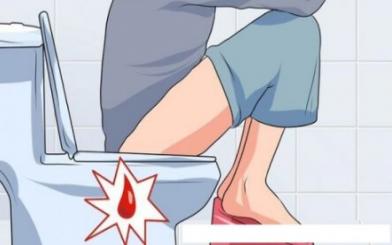 Ngứa rát chảy máu hậu môn: Nguyên nhân và cách điều trị