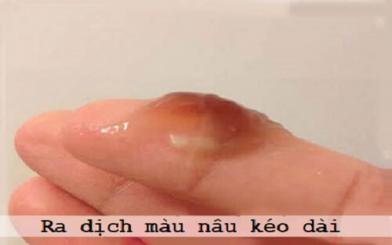 [Cảnh báo nguy hiểm] Ra dịch màu nâu kéo dài!