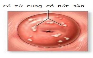 Cổ tử cung có nốt sần và cách chữa hiệu quả