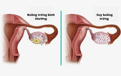 Nhận biết dấu hiệu suy buồng trứng và cách chữa trị