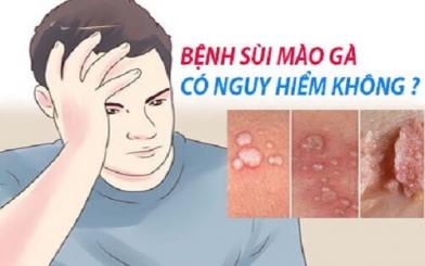 Sùi mào gà có nguy hiểm không? Có chữa được không?