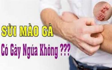 Sùi mào gà có ngứa không? Có chữa được không?