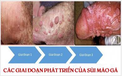 [Giải đáp] Bệnh sùi mào gà phát triển nhanh không?