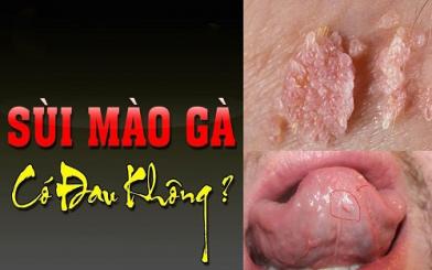 [Giải đáp…] Sùi mào gà có đau không? 